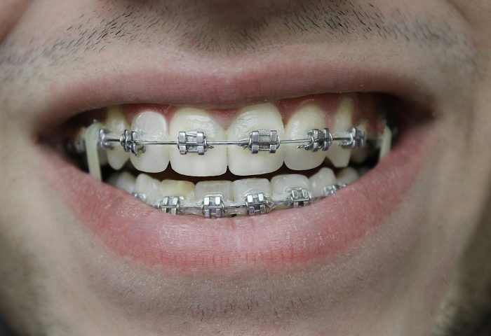 ارتودنسی دندان چقدر طول میکشد
