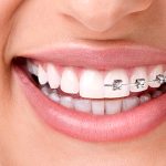 چه زمانی ارتودنسی برداشته میشود