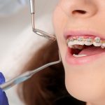 چه زمانی ارتودنسی برداشته میشود