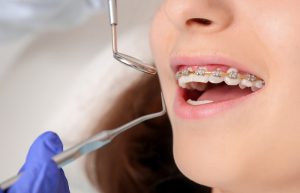 چه زمانی ارتودنسی برداشته میشود