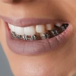 ارتودنسی فک پایین چقدر طول میکشد